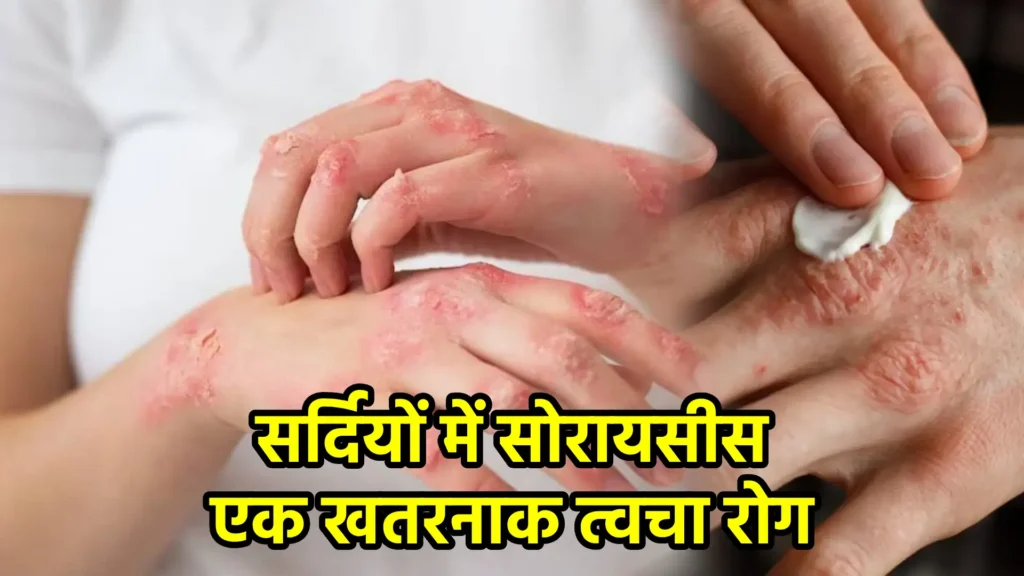 सर्दियों में सोरायसीस: एक खतरनाक त्वचा रोग